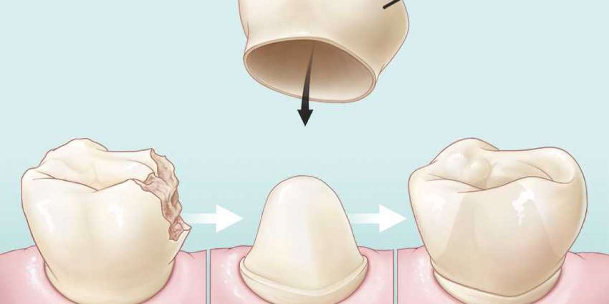 .zip Picture Of A Crown For Teeth Torrent Registration Full