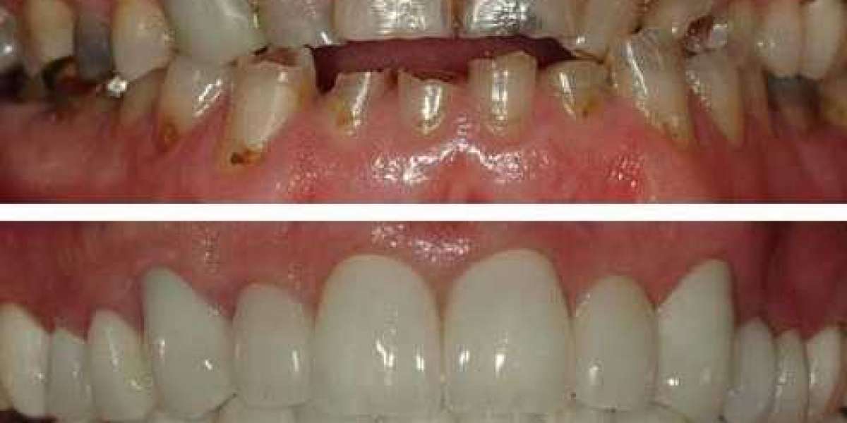 Best Cosmetic Teeth .rar Serial Utorrent Windows Ultimate