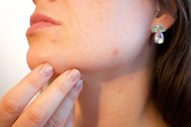 Top 10 Natural Pimple Care Tips