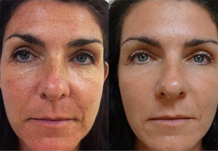 How to get glowing skin back with the best C02 laser resurfacing? - Apkhuts