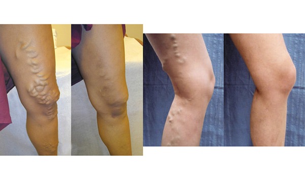 A To Z Of Profhilo Treatment Prices In Uk: