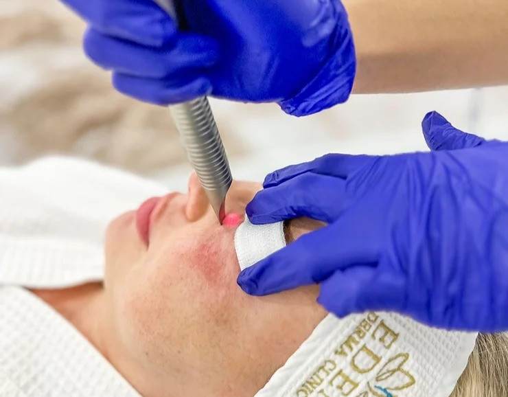 Spider Veins, Sclerotherapy & Vascular Lesions | EDEN AESTHETICS