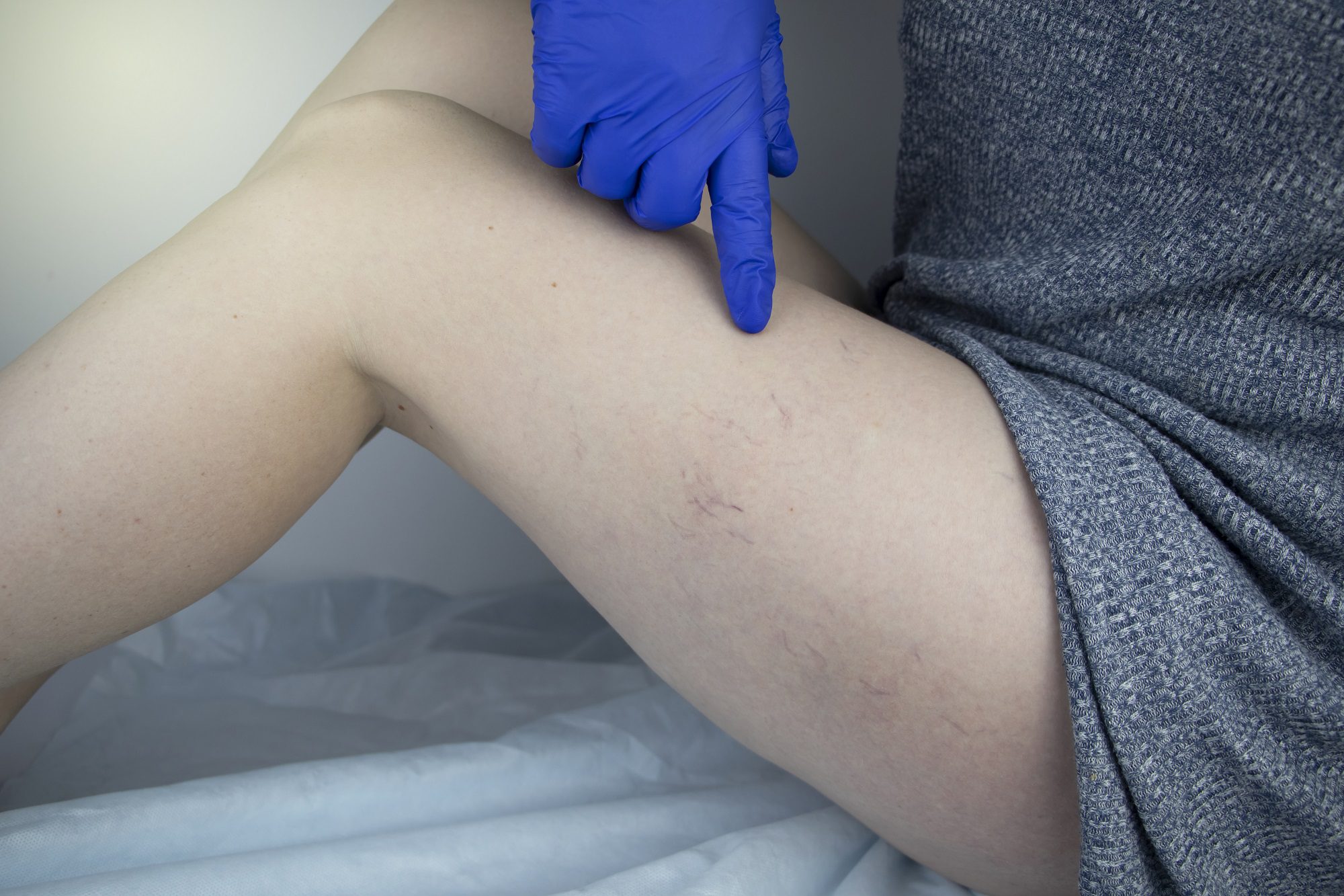 Varicose Veins Treatment in Chandigarh: Minimally Invasive Marvels