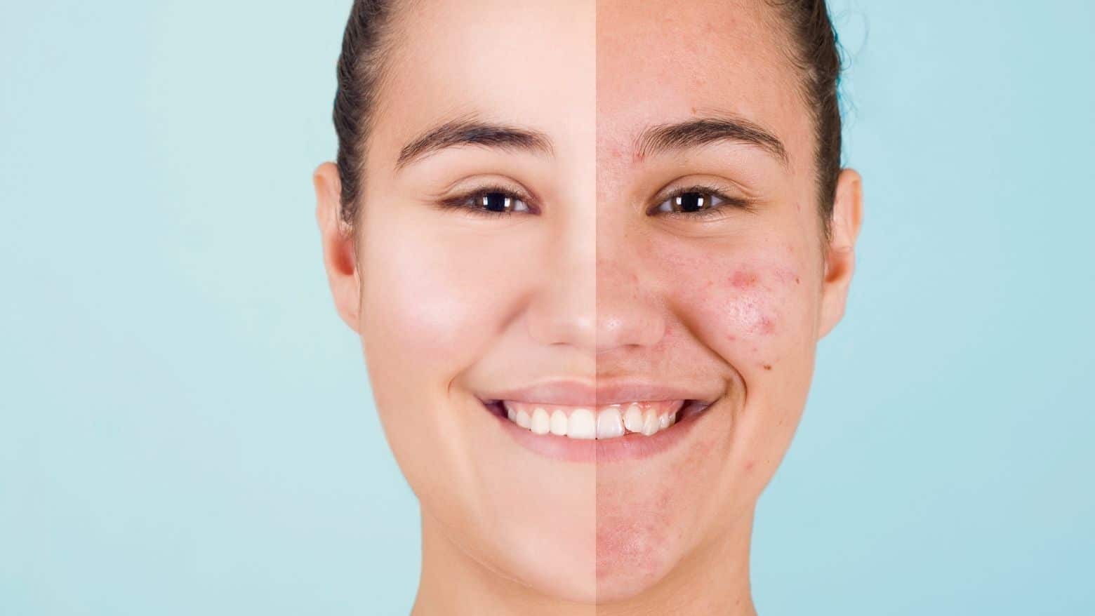 Why Do You Get Acne: Is it Something to Do with Hormones?