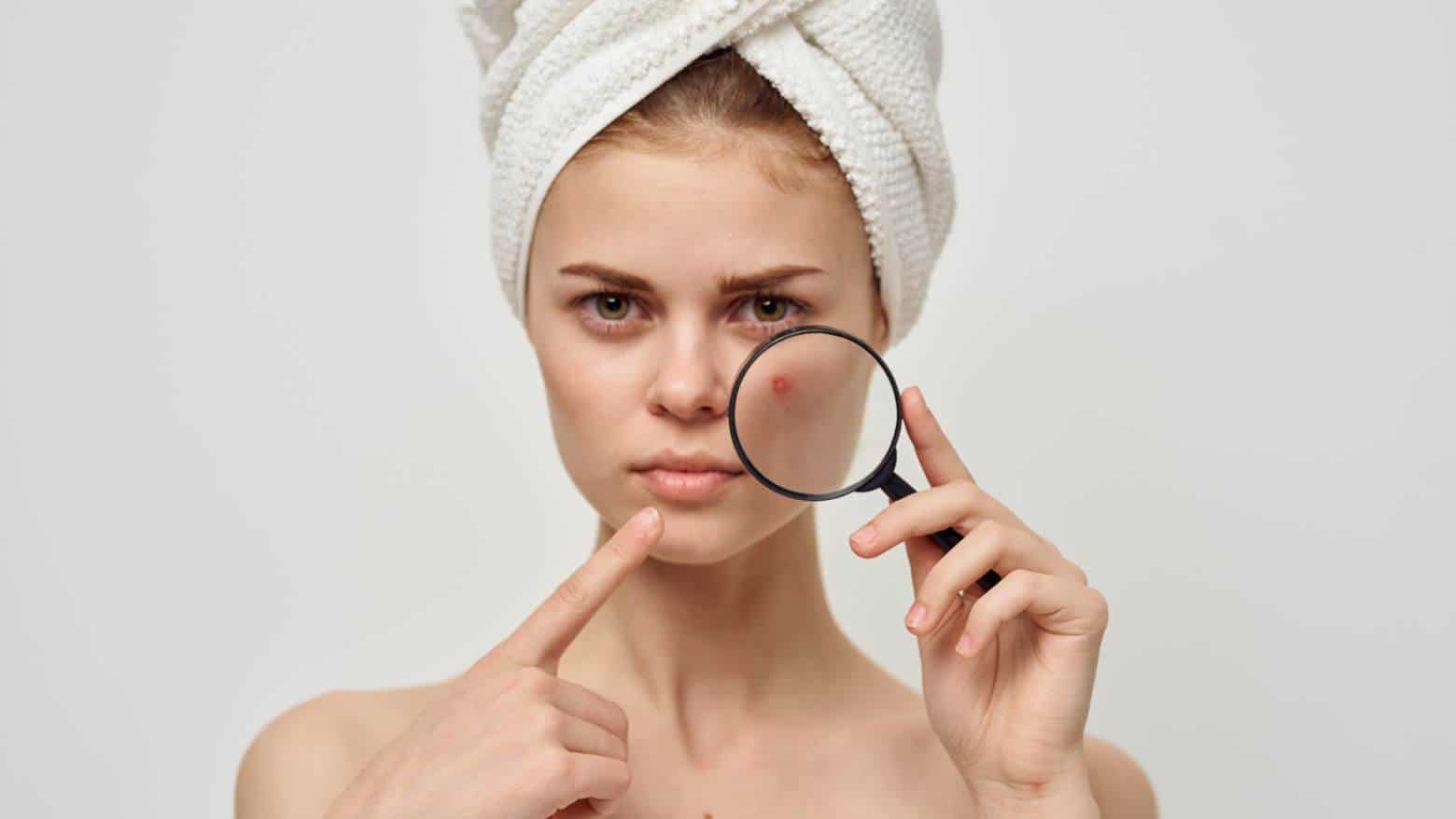 How To Stop Acne: Effective Strategies to Achieve Clear Skin