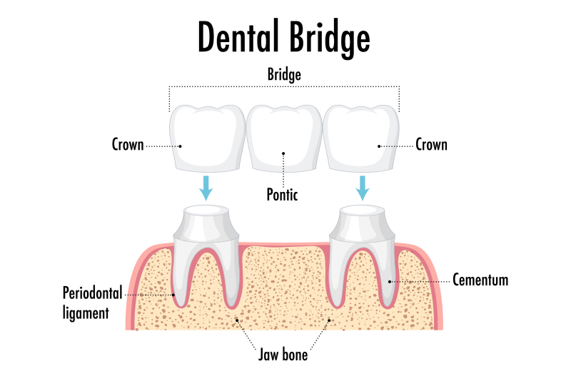 Dental Crowns and Bridges in Portland, TX | Restore Your Smile