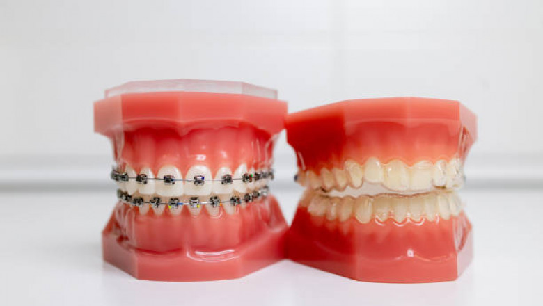 Invisalign vs. Traditional Braces: Which Orthodontics Option is Right for You? | Times Square Reporter