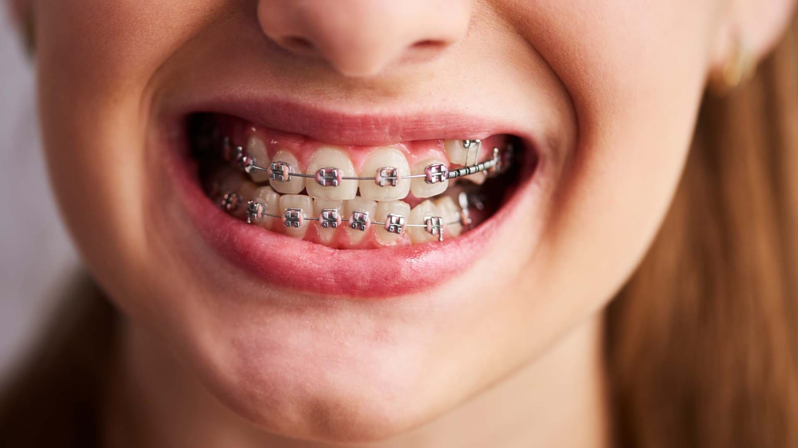 Dental Braces Solutions for Adults in Abu Dhabi