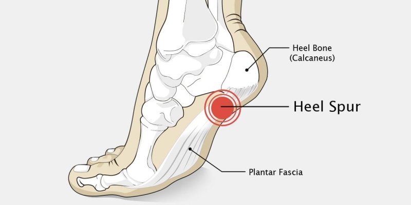 Best Calcaneal Spur Trearment In Gurgaon