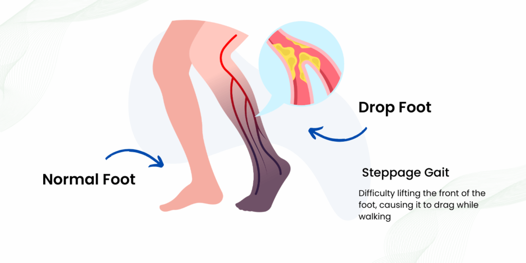 Best Foot Drop Treatment In Gurgaon