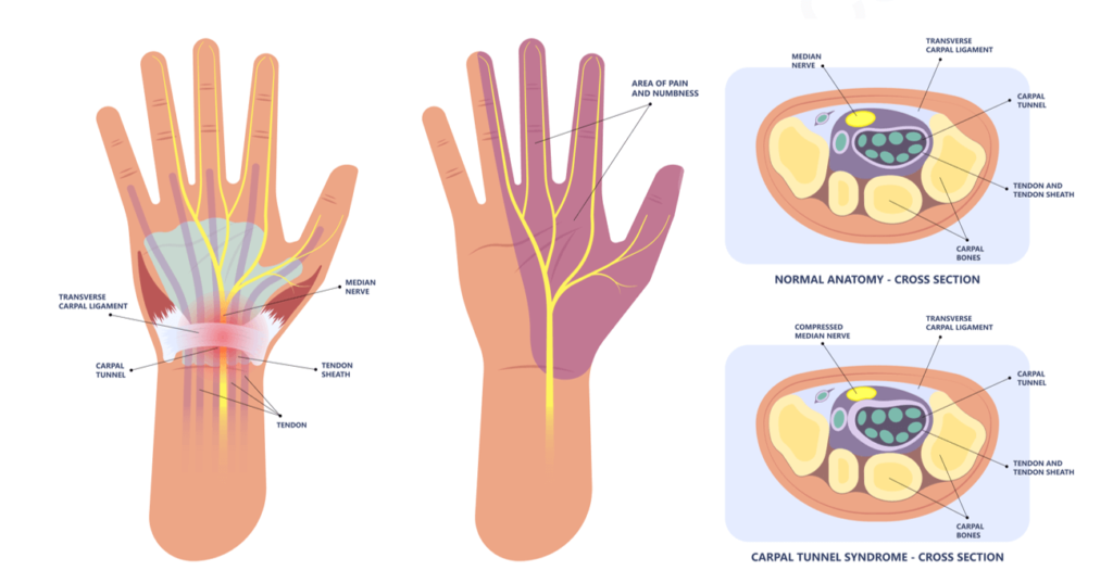 Best Carpal Tunnel Syndrome Treatments In Gurgaon